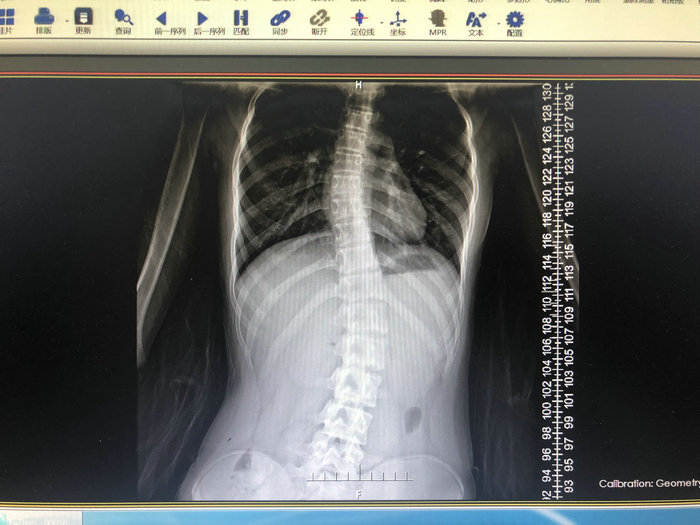 苏城女孩严重S形脊柱侧凸 这些症状不可忽视 (1).jpg