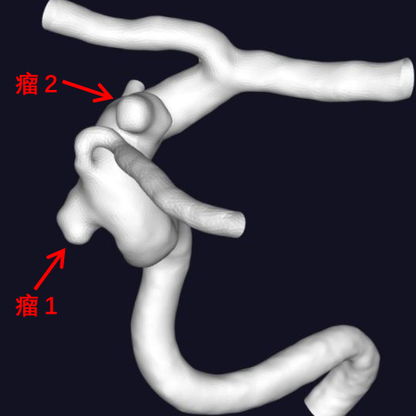 小眼病牵出动脉瘤，我院联手鼓楼医院为患者排忧解难!.png