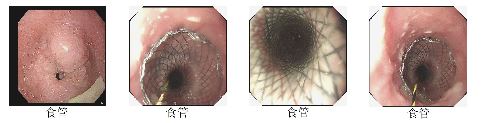 老人食管再狭窄，叠加支架置入解决难“咽”之隐.jpg