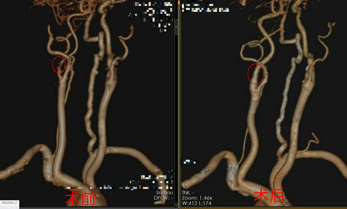 男子眼睛看不清，一查竟是颈动脉狭窄！.JPG