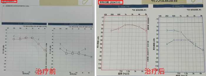 反复眩晕可能得了梅尼埃病，南大苏州医院手术治疗可控制.png