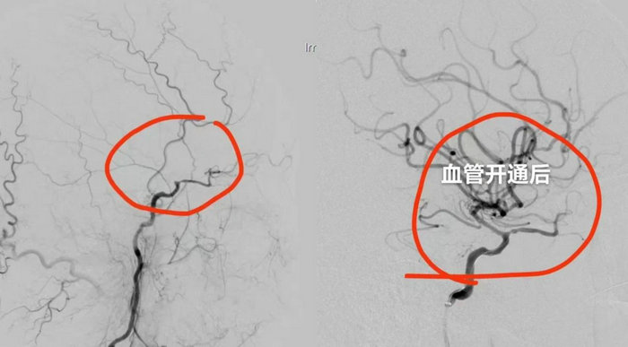 男子脑血管慢性闭塞，我院神经介入技术助力疏通大脑“生命线”2.JPG