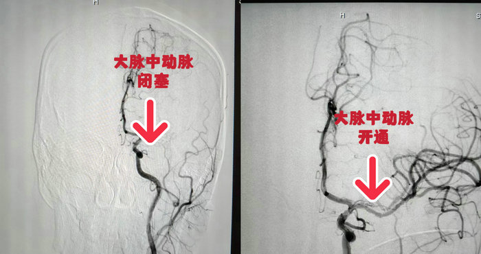 27岁小伙突发急性脑梗，这个高危习惯可能你也有…….jpg