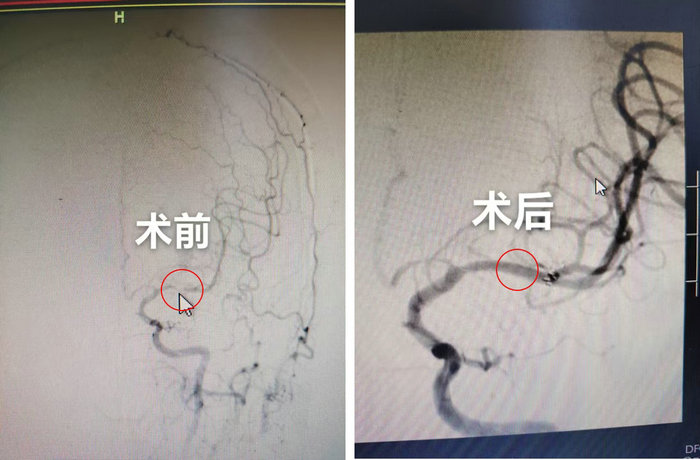 南大苏州医院开展复杂大脑中动脉支架置入术 高危脑梗患者获救_1.jpg